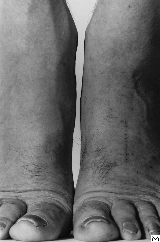 Feet Frontal , 1984©The John Coplans Trust
